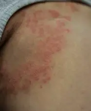 완선
