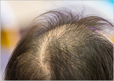 탈모로 고민하는 여성과 탈모 증상 이미지