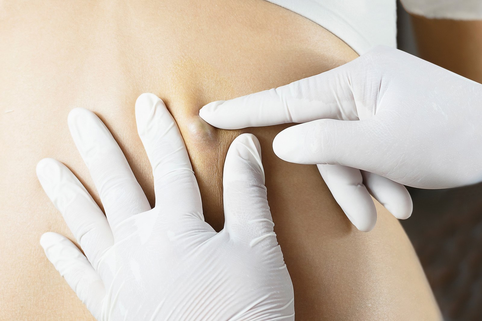모소낭(Pilonidal Sinus): 원인, 증상, 치료 및 예방