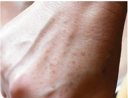 검버섯 없애는 방법