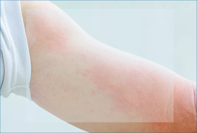 피부 두드러기
