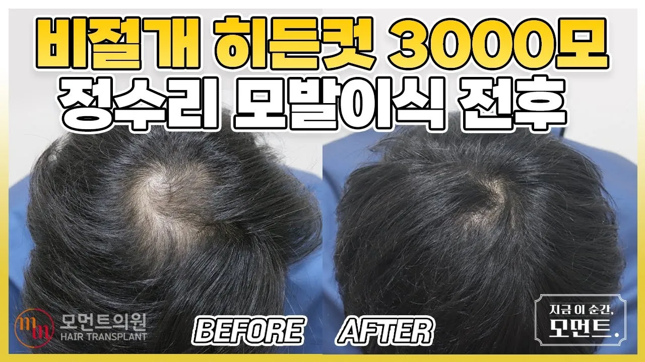 정수리가 아픈 이유와 완화하는 방법_1