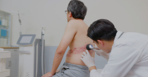 대상포진