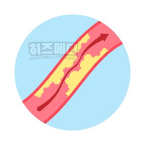 안구 건조증 증상