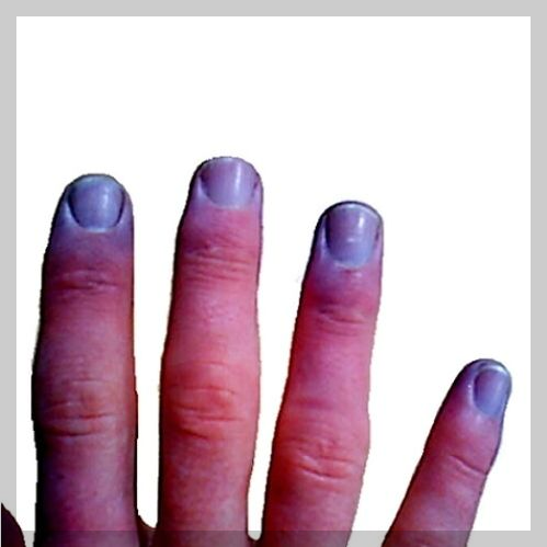 호흡기질환 ; 청색증- 종류, 원인, 증상, 진단방법, 치료방법.