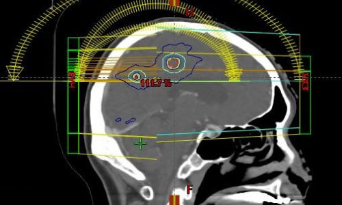 정위적 방사선수술(SRS)