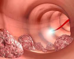 대장내시경 비용 총정리
