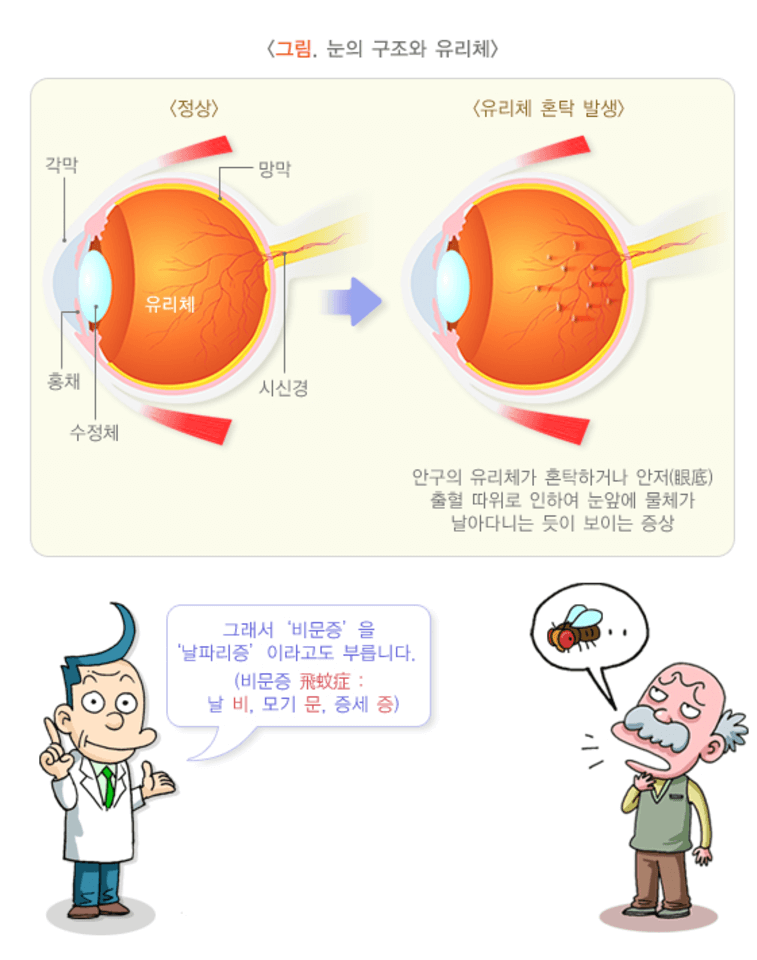 비문증 치료방법 원인 좋은 음식