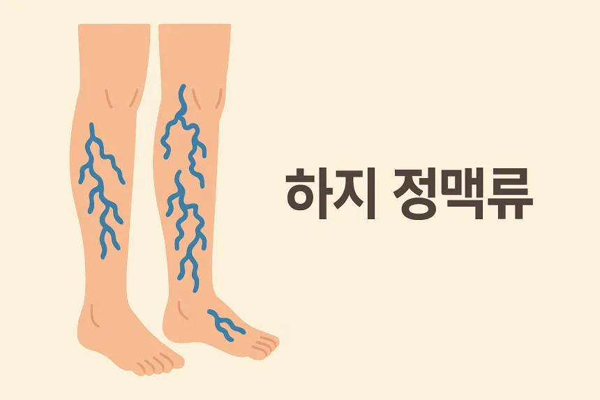 하지 정맥류 증상