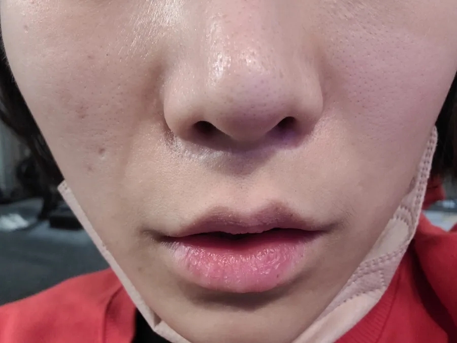 인중 축소 수술 후기