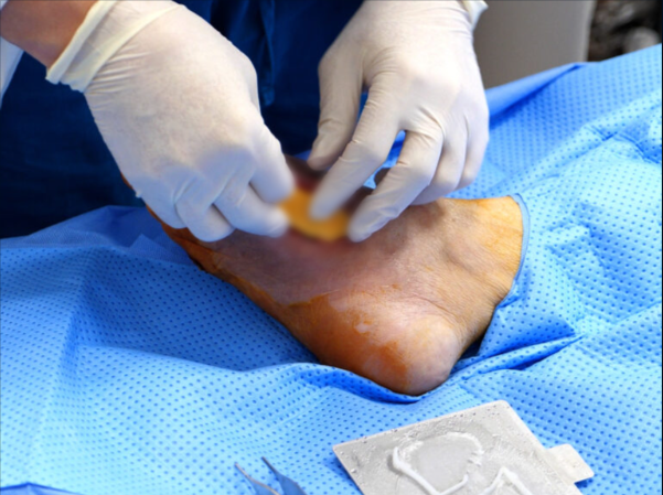Affected area patch transplant :After implanting the patch on the affected area, the procedure is completed and the regeneration process is observed.Secure regenerative treatment results with economical and highly efficient treatment technology