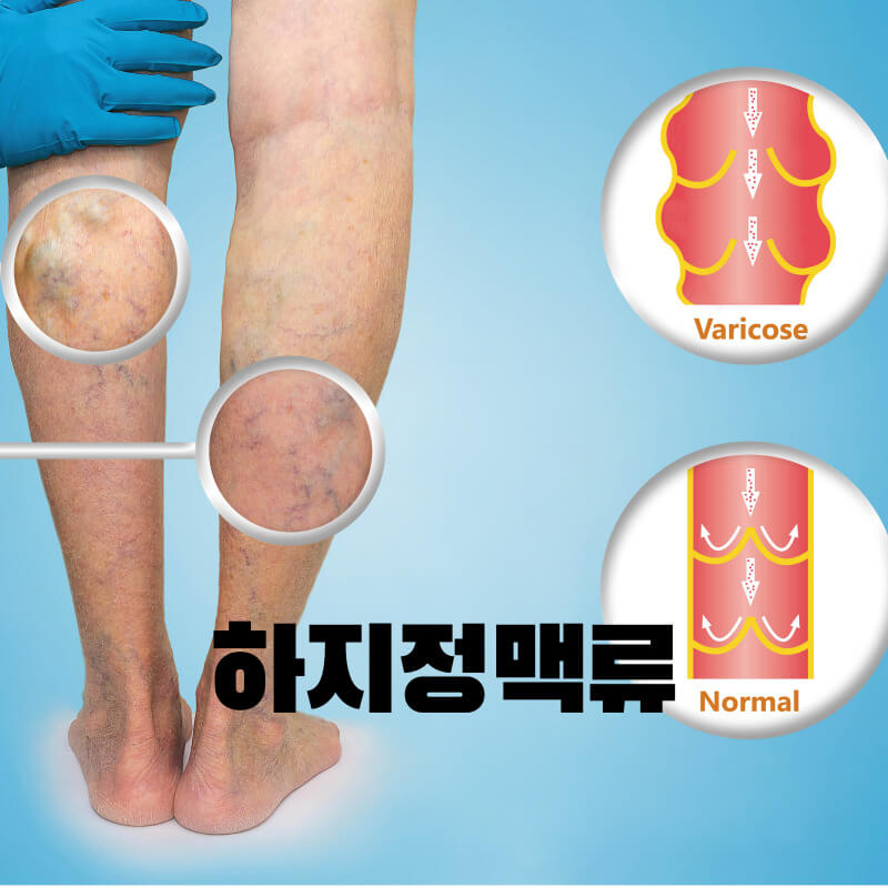 하지정맥류