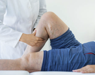 하지정맥류 증상 수술비용 좋은운동 등 총정리(2024 최신)