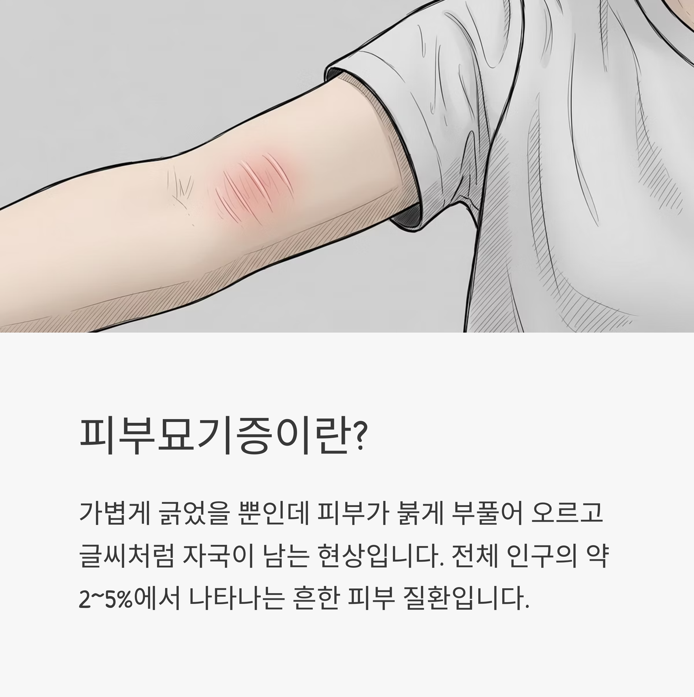 피부묘기증이란?
