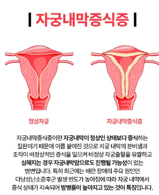 자궁내막증식증