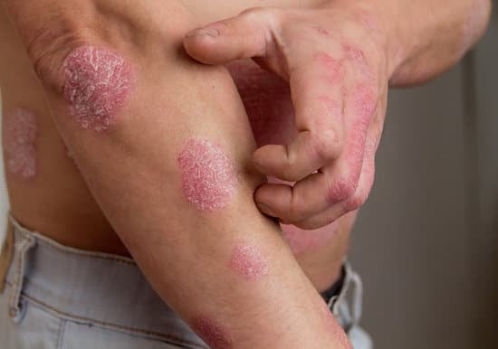 건선(Psoriasis): 원인, 증상, 치료 방법