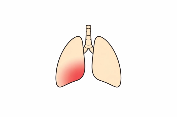 암환자 산정특례 제도