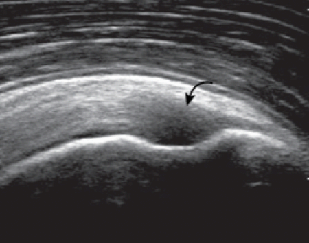 supraspinatus tendon anisotropy