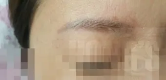 눈썹 문신 제거 방법 꿀팁_23
