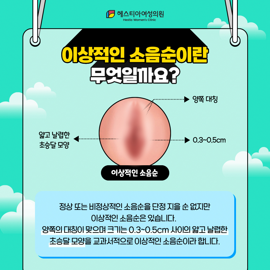 이상적인 소음순이란?