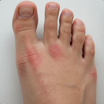 발등 통증에 좋은 약 추천