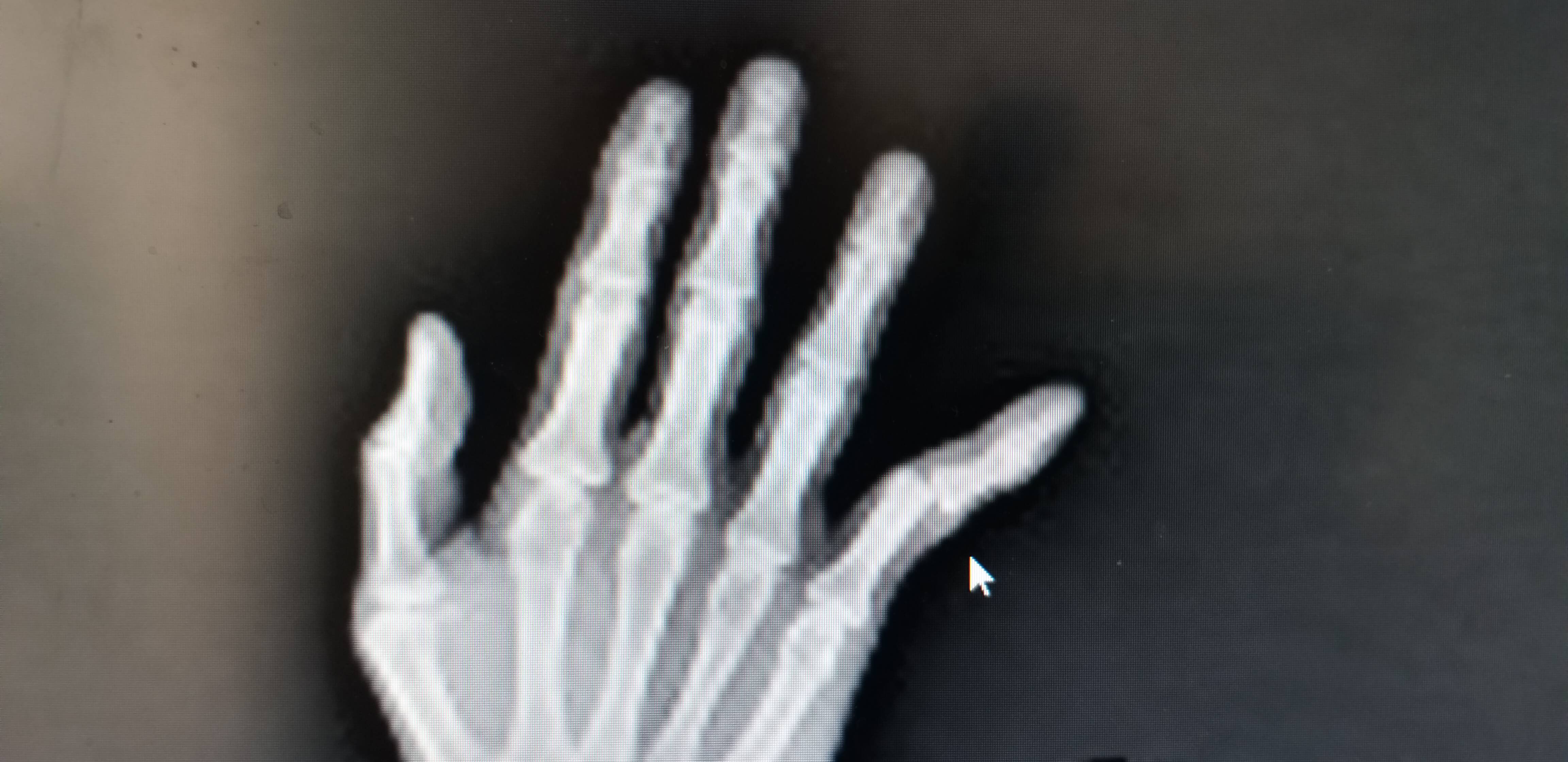 손가락인대파열사진촬영1