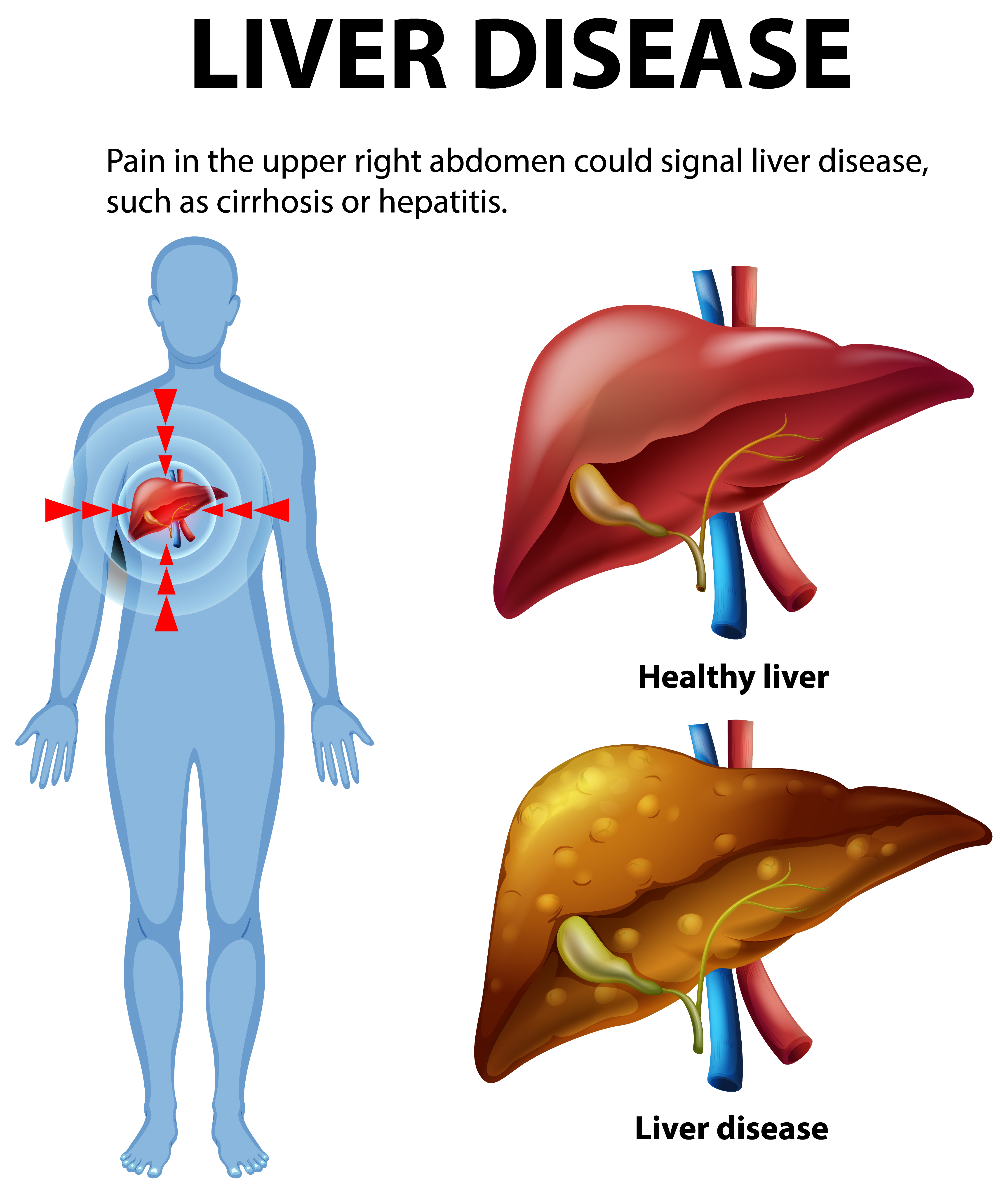 간 수치 낮추기