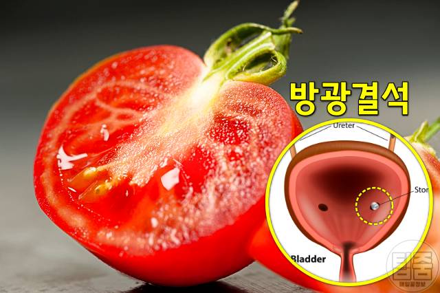요로결석 녹이는 음식 토마토 요로결석 좋은 음식