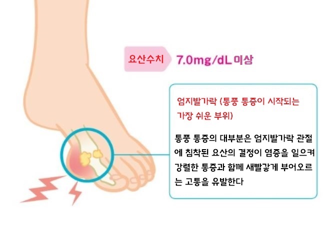 통풍과 요산수치