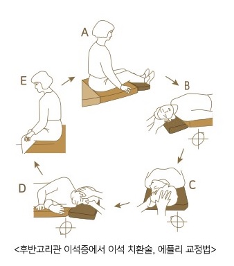 이석 치환술