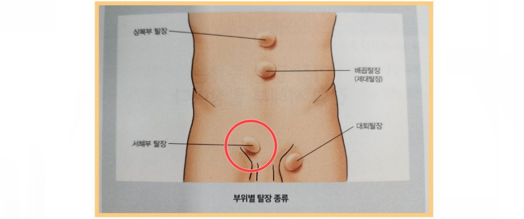탈장종류-표시그림