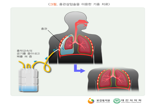 기흉 관련 수술