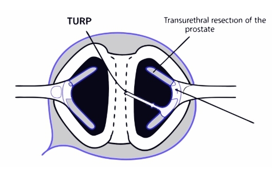 전립선비대증 수술 과정