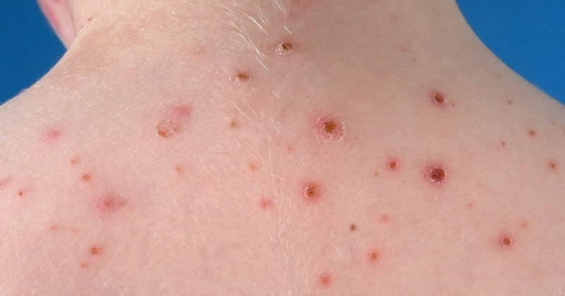 병변에 딱지가 앉은 우두모양 물집증