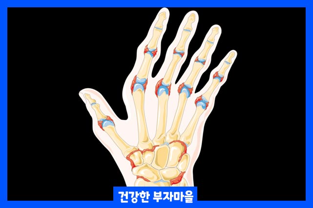 관절염