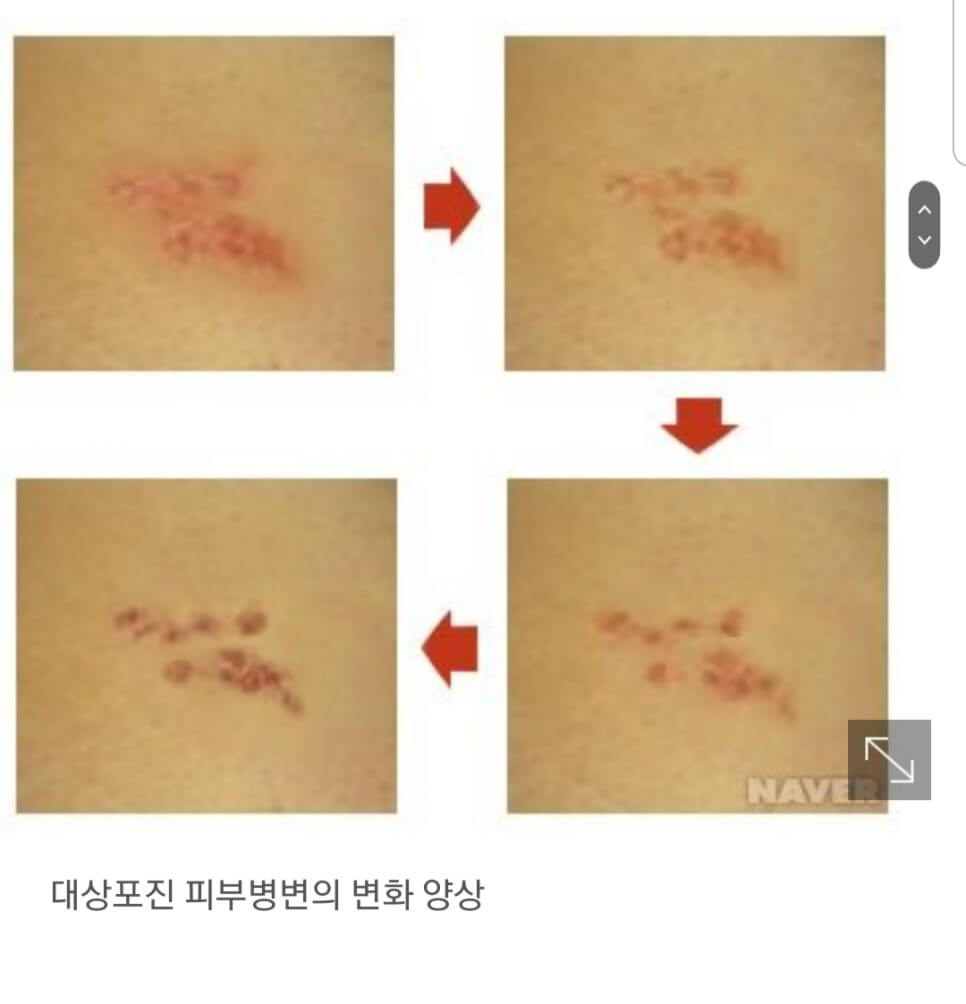 대상포진 피부병변