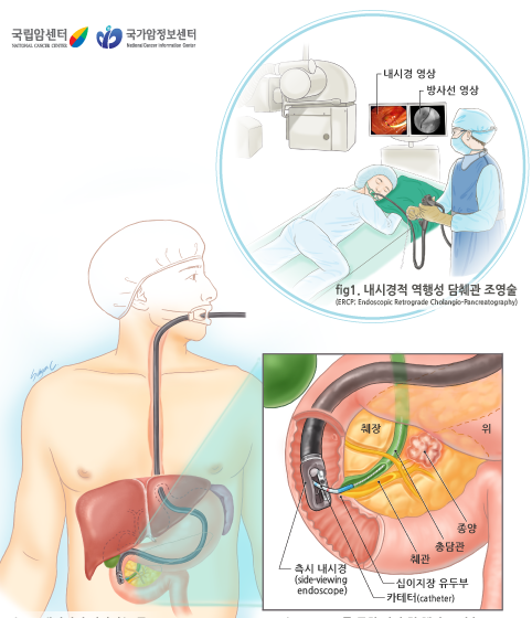 내시경적 역행성 담췌관조영술(ERCP)