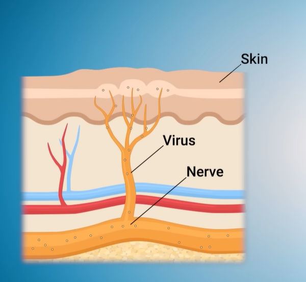 헤르페스 2형 증상