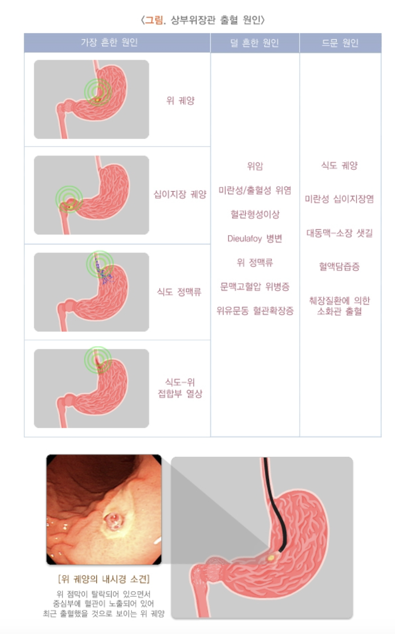 상부위장관 질환