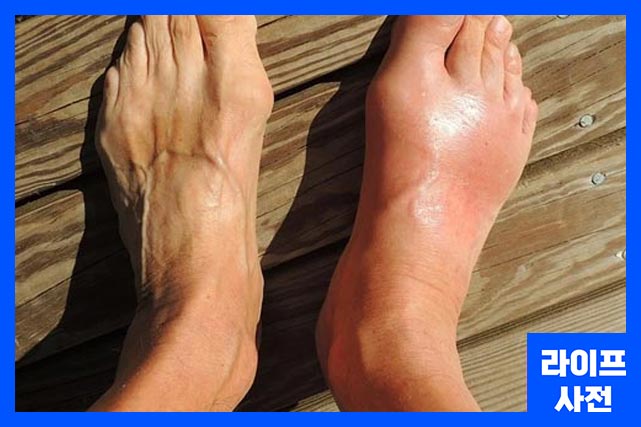 염좌는 발목 통증 원인 중 하나입니다.