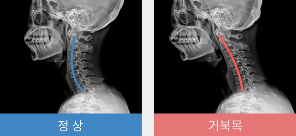 정상목과 거북목