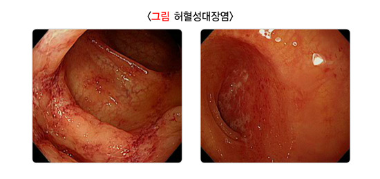 허혈성대장염