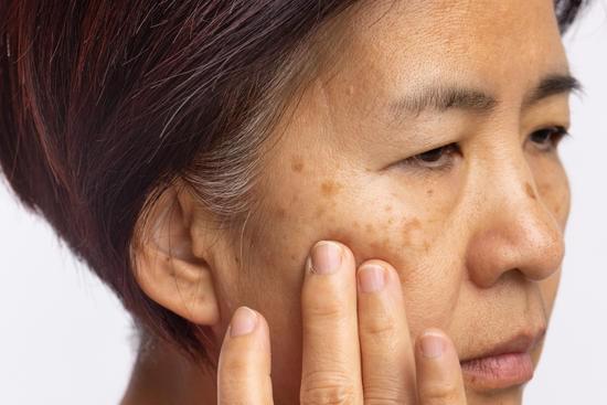 색소 침착 완화를 위한 효과적인 방법과 관리법