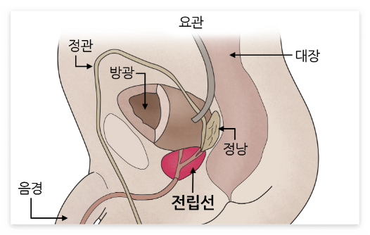 전립선염
