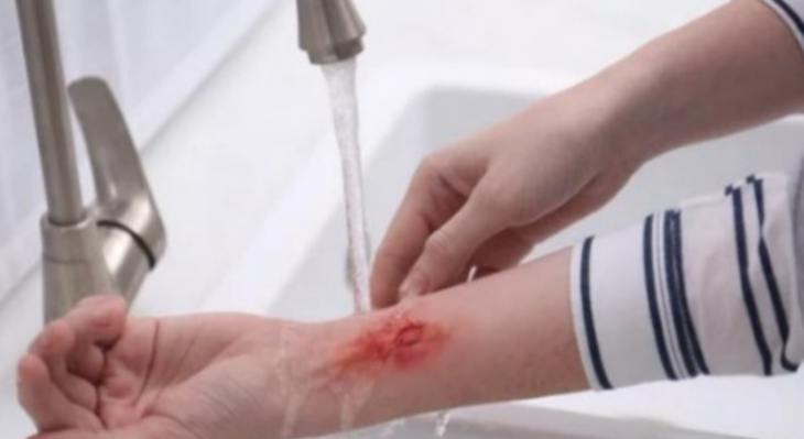 화상-응급처치법