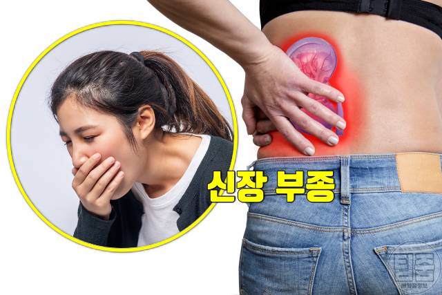 요로결석 증상 구역질 요로결석 신장결석 차이 요로결석자연배출