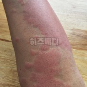 백일해 예방접종