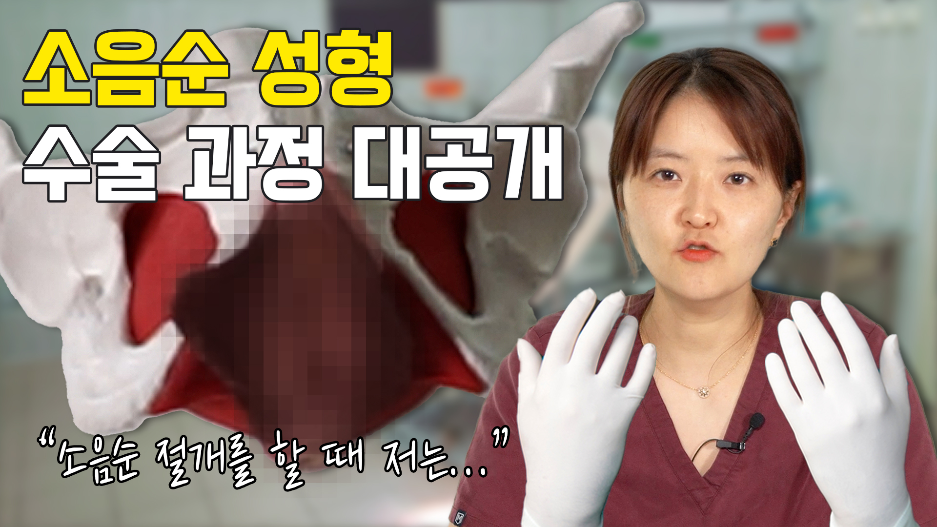소음순성형수술 과정 대.공.개 ※수술 시물레이션 포함!