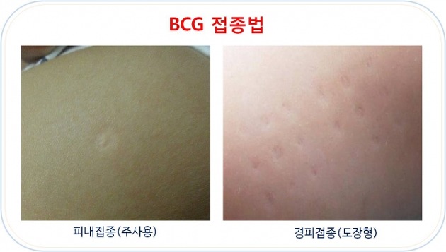BCG 접종, 필요한 이유와 피내용 vs 경피용 완벽 비교!