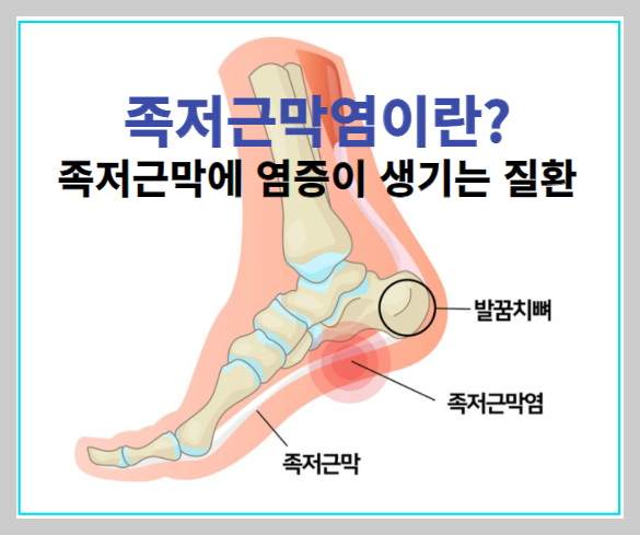 족저근막염 증상 자가 치료법 깔창 선택 방법